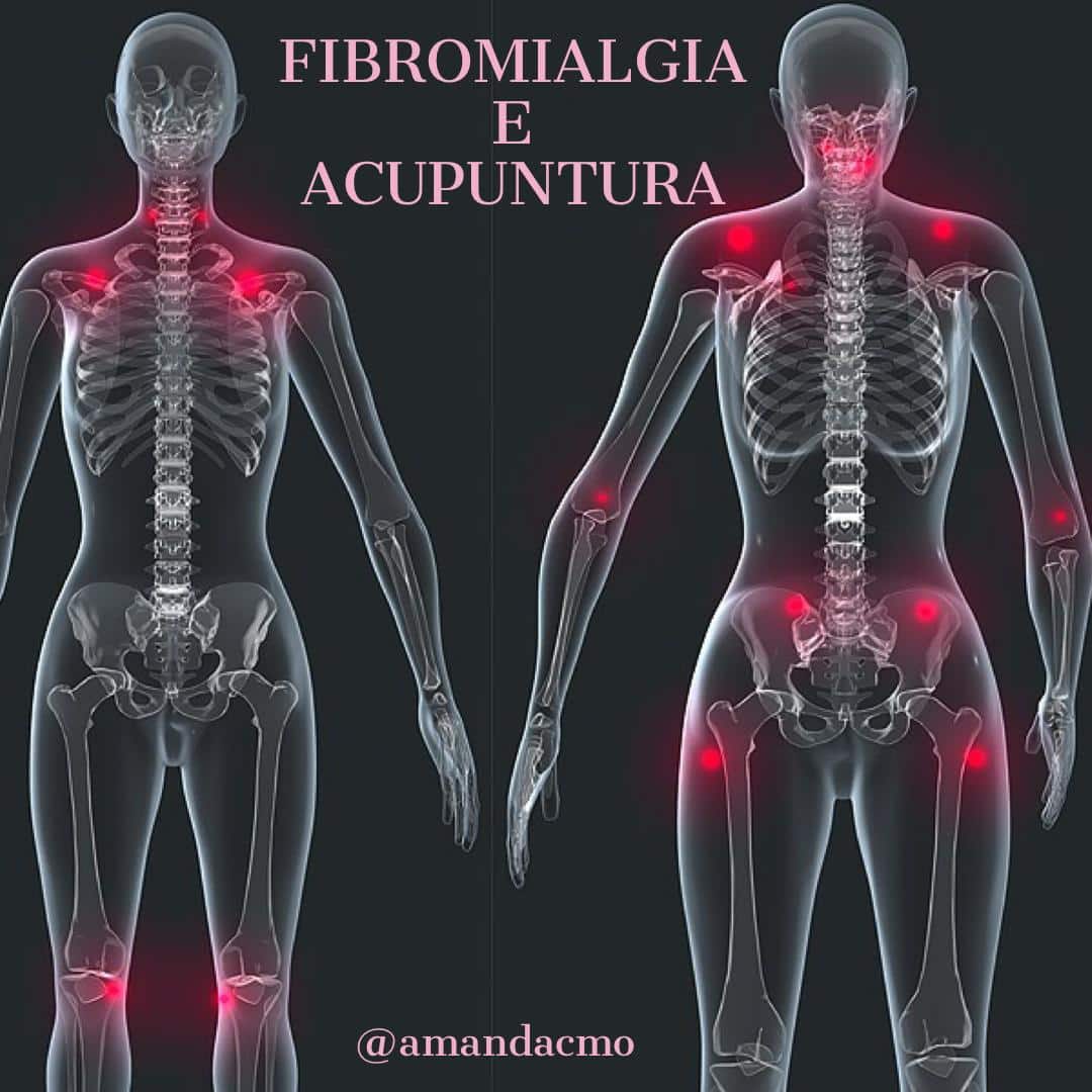 Acupuntura e Fibromialgia