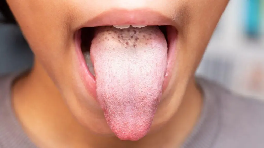 Diagnóstico pela língua – Saburra e suas características